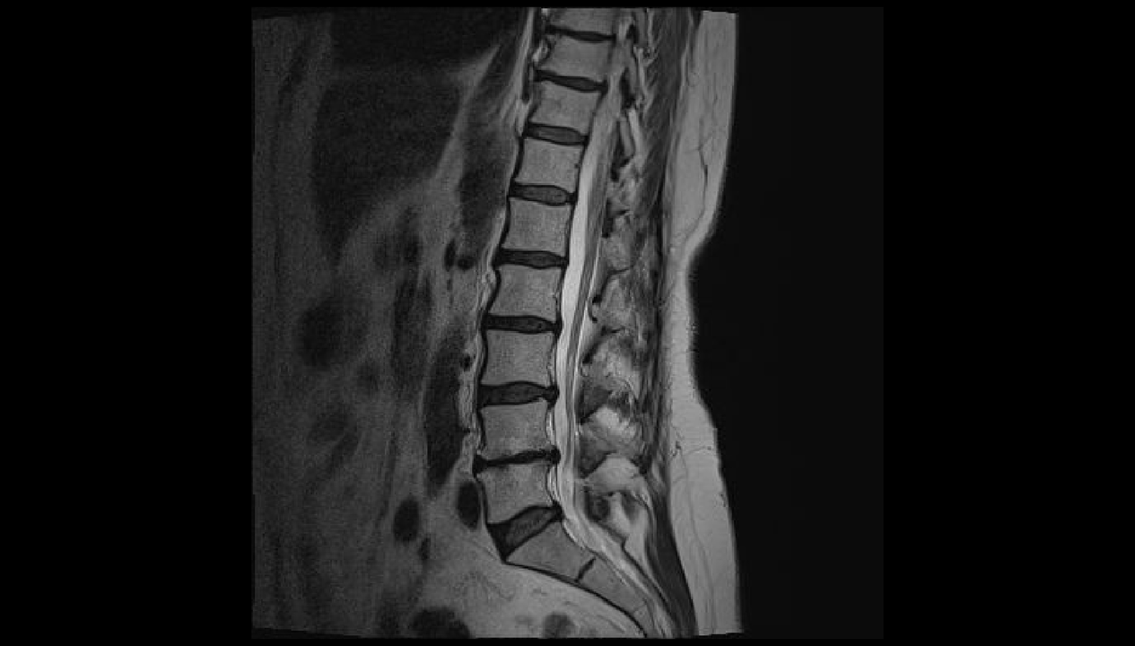 bizkarreko minaren diagnostikoa gerrialdeko eskualdean