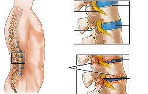 gerrialdeko bizkarrezurraren osteokondrosiaren arrazoiak