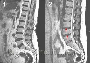 osteochondrosis bizkarrezurra