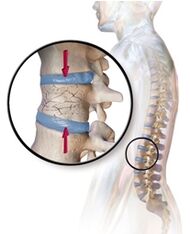 Osteoporosiak bizkarreko mina eragiten du gerrialdean